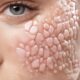 healing pimples with patches