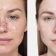 pimple patches effective treatment