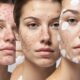 pimple patches treat acne