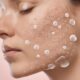 understanding hydrocolloid acne patches