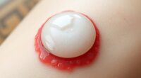 pimple patch for cold sore