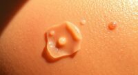 pimple patches on moles