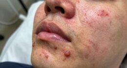 avoid patching breakouts prematurely