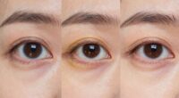 different treatments for dark circles