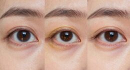 different treatments for dark circles