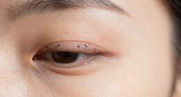 incorrect eye microcurrent placement