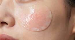 wear patches until clear