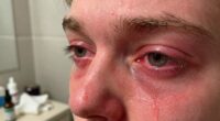 adjusting eye hygiene practices