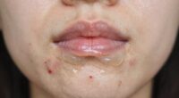 chin acne patch behavior