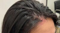 crown hair breakage solution