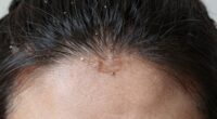 detecting early scalp buildup
