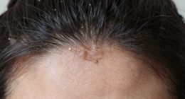 detecting early scalp buildup