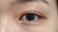distinguishing eye puffiness