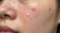 effective for certain blemishes