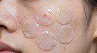 excess salicylic acid patches