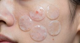 excess salicylic acid patches