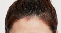 headache from tight hairstyles