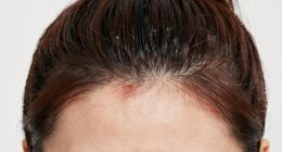 headache from tight hairstyles