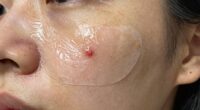 ineffective pimple treatment methods