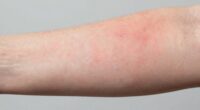 invisible early skin damage