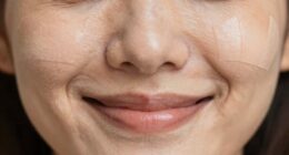 patch positioning affects wrinkles