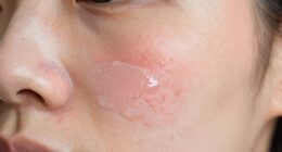 pimple patch duration guidelines