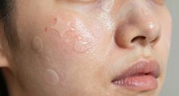 pimple patches aren t universal