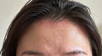 post styling scalp soreness