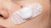 quick whitening on certain pimples