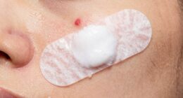 quick whitening on certain pimples