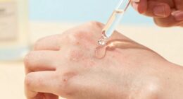 sensitive skin exfoliation risks