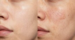 skin texture versus congestion