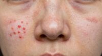 targeted spot treatment effectiveness
