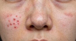 targeted spot treatment effectiveness