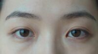 tiredness doesn t always cause dark circles