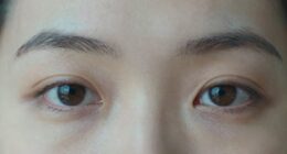 tiredness doesn t always cause dark circles