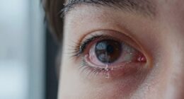 winter causes increased eye stinging